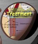 Breast Cancer Treatment