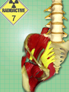 radiation fibrosis of lumbosacral plexus