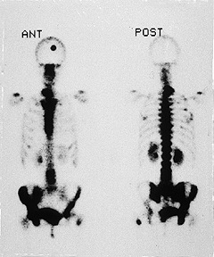 Bone Scan