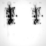 bone scan