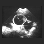ultrasound